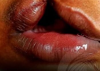 OMATAPALO apoia campanha de cirurgias gratuitas para crianças com lábio leporino