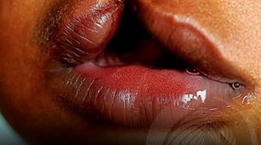 OMATAPALO apoia campanha de cirurgias gratuitas para crianças com lábio leporino